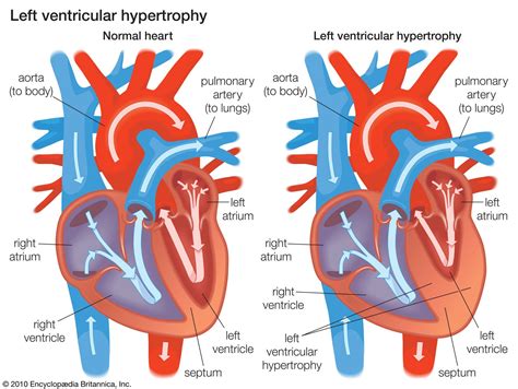 is left ventricular hypertrophy considered heart failure.